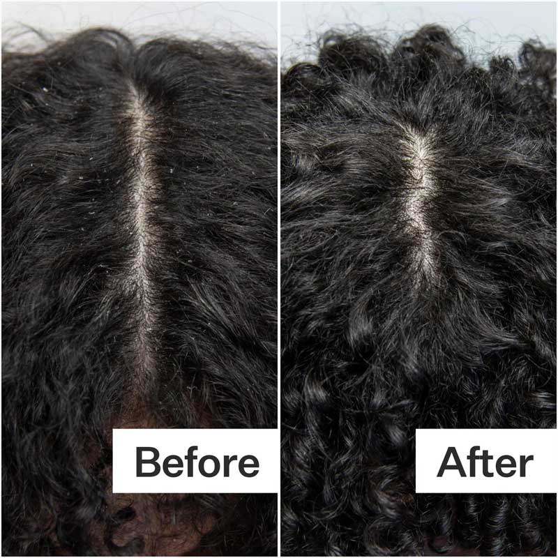 Act+Acre Scalp Build-Up System