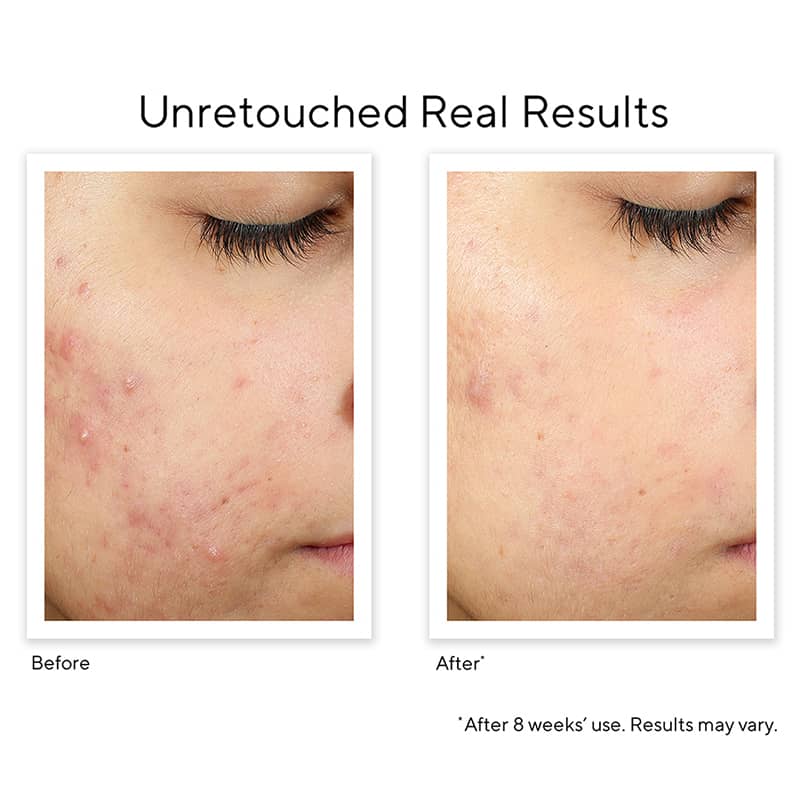 Murad Blemish Control InvisiScar Resurfacing Treatment