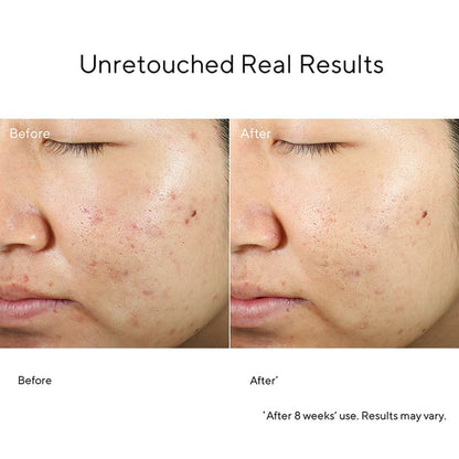Murad Blemish Control InvisiScar Resurfacing Treatment