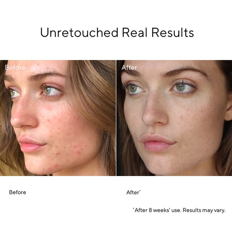 Murad Blemish Control InvisiScar Resurfacing Treatment