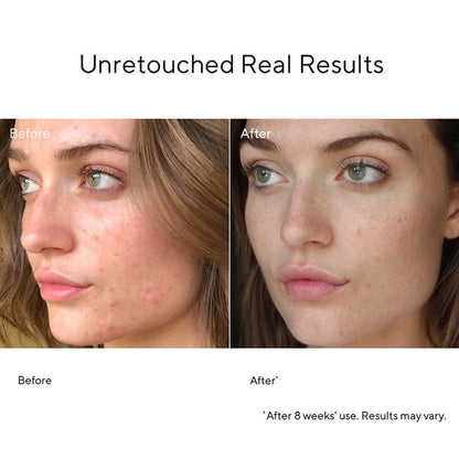 Murad Blemish Control InvisiScar Resurfacing Treatment